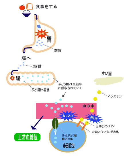 糖尿病発症の仕組み