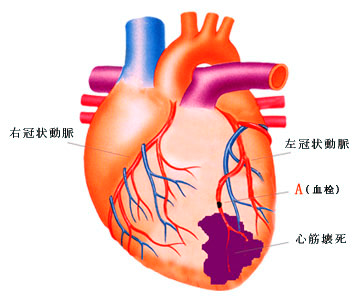 心筋梗塞の図